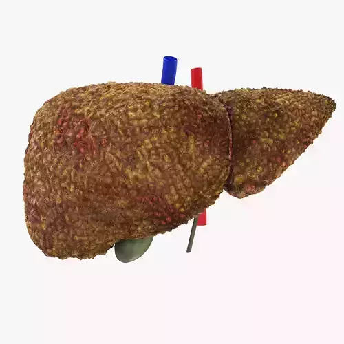 Cirrhosis Liver