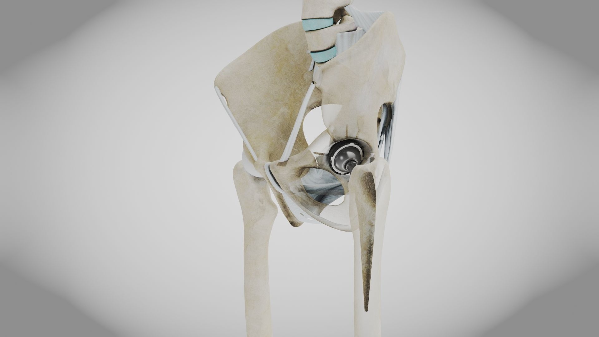 Replaced Hip Implant Low-poly 3D model_28