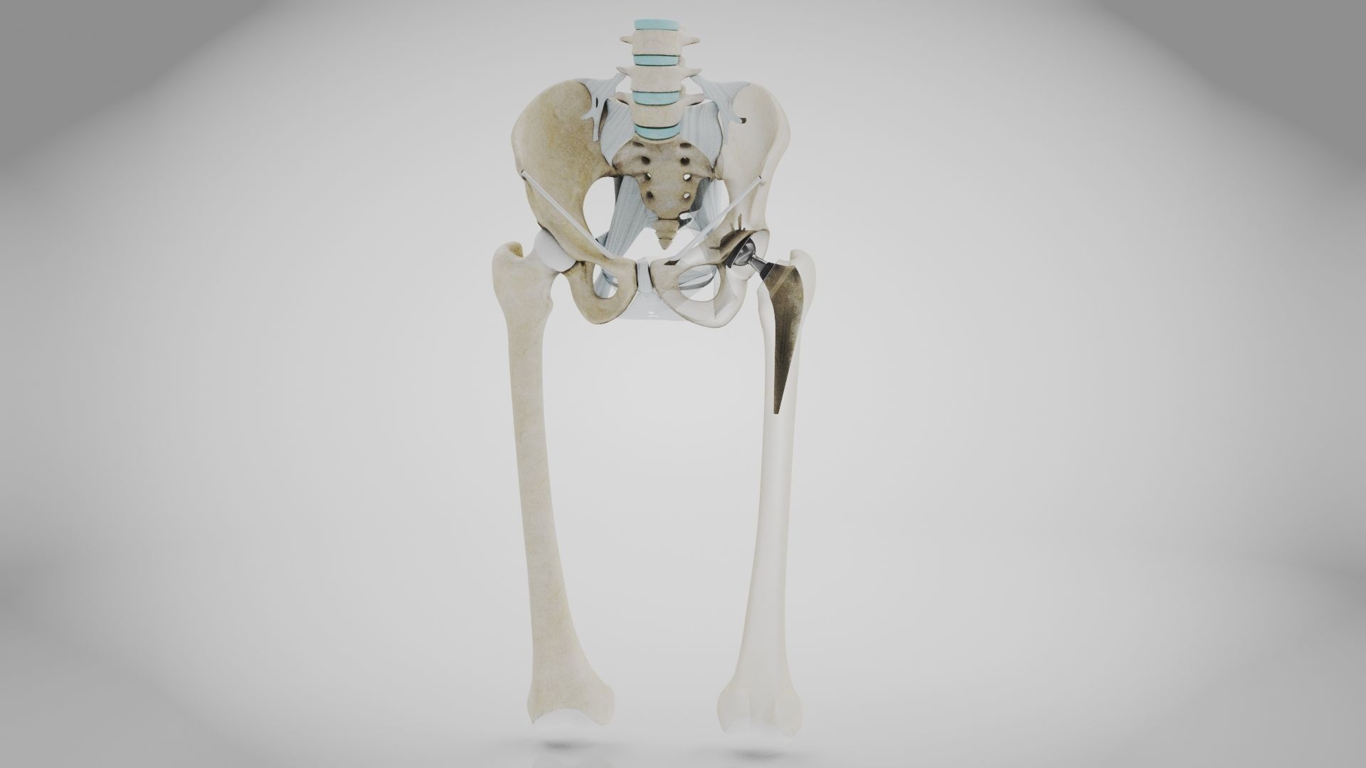 Replaced Hip Implant Low-poly 3D model_30
