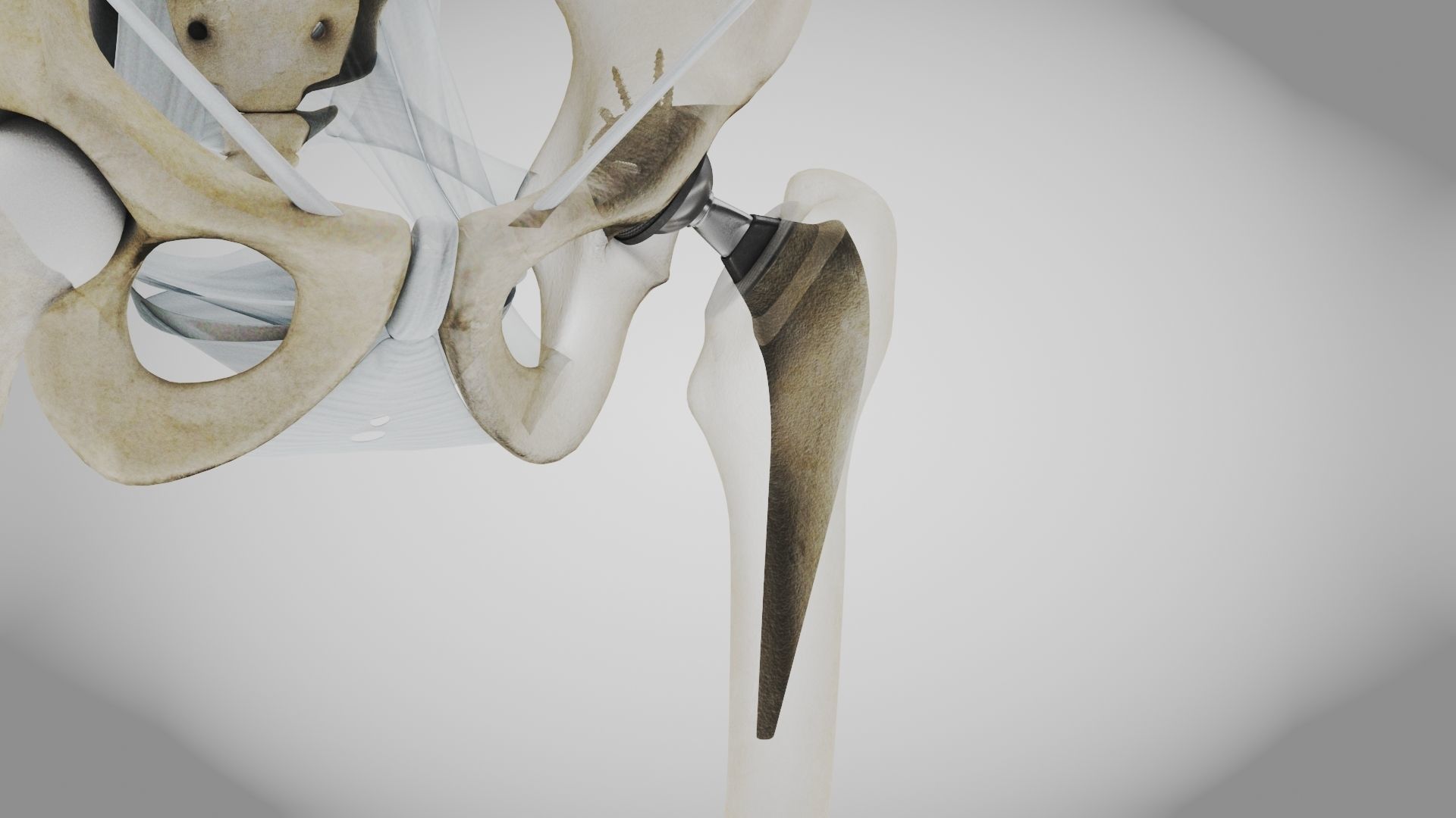 Replaced Hip Implant Low-poly 3D model_32