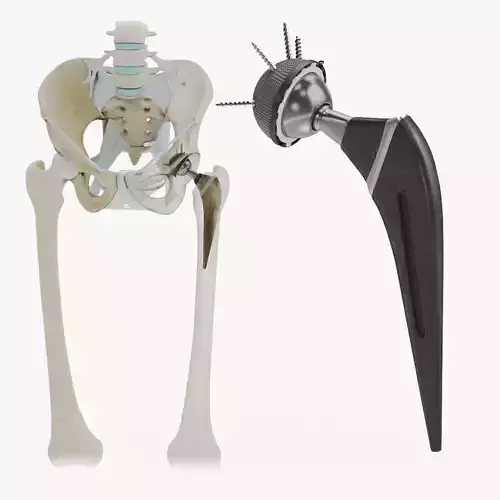 Replaced Hip Implant Low-poly 3D model Replaced Hip Implant Low-poly 3D model