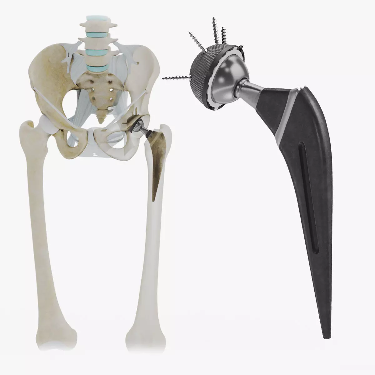 Replaced Hip Implant Low-poly 3D model_0