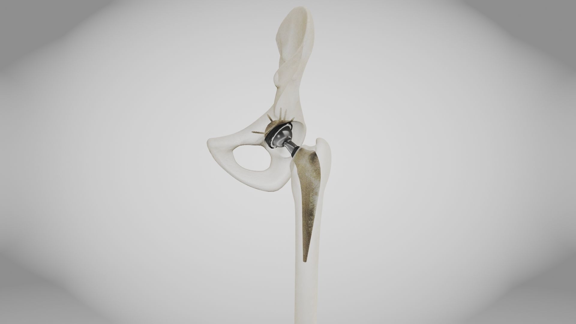 Replaced Hip Implant Low-poly 3D model_3