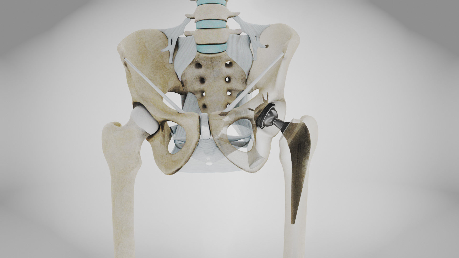 Replaced Hip Implant Low-poly 3D model_31