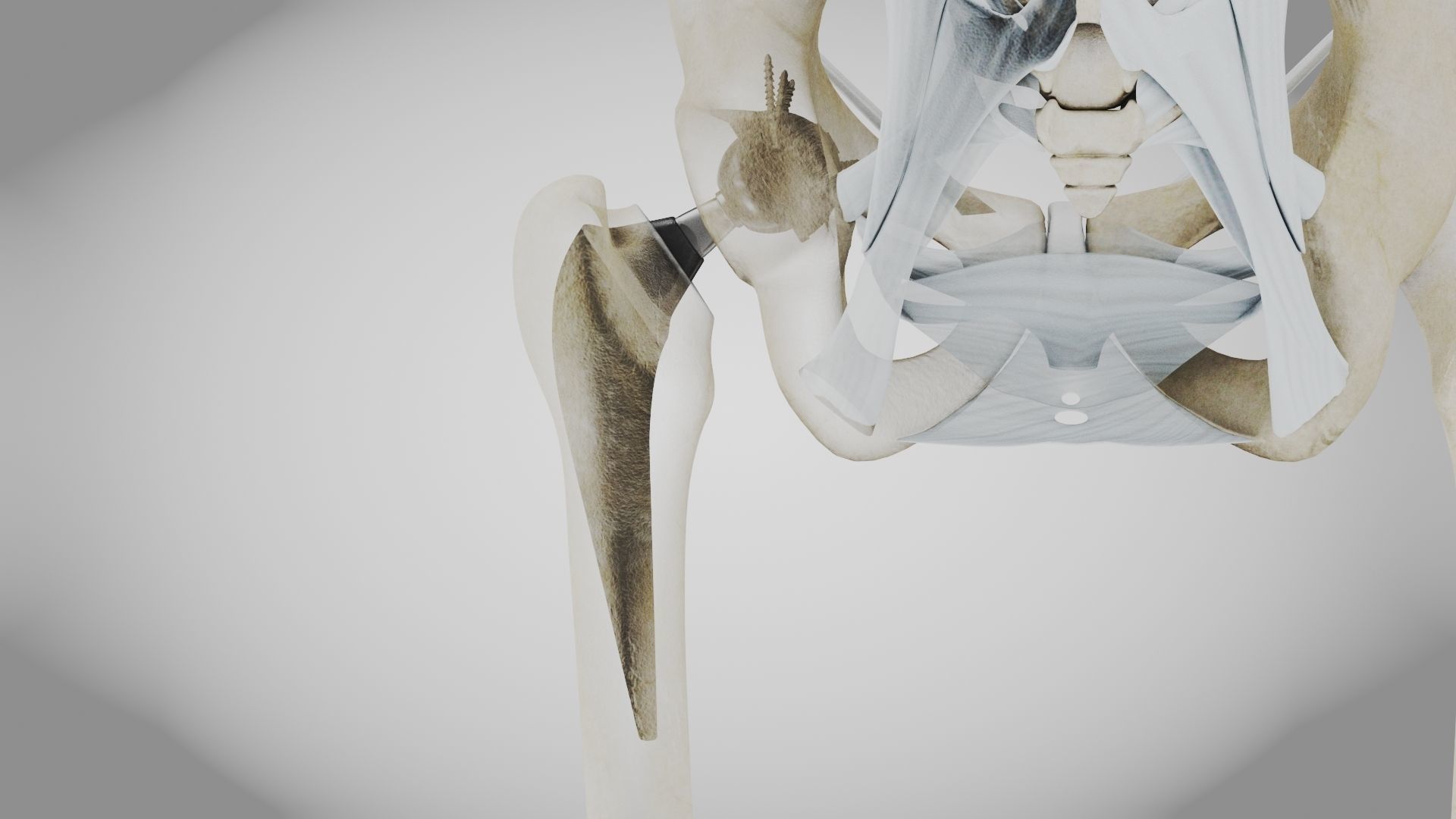Replaced Hip Implant Low-poly 3D model_2