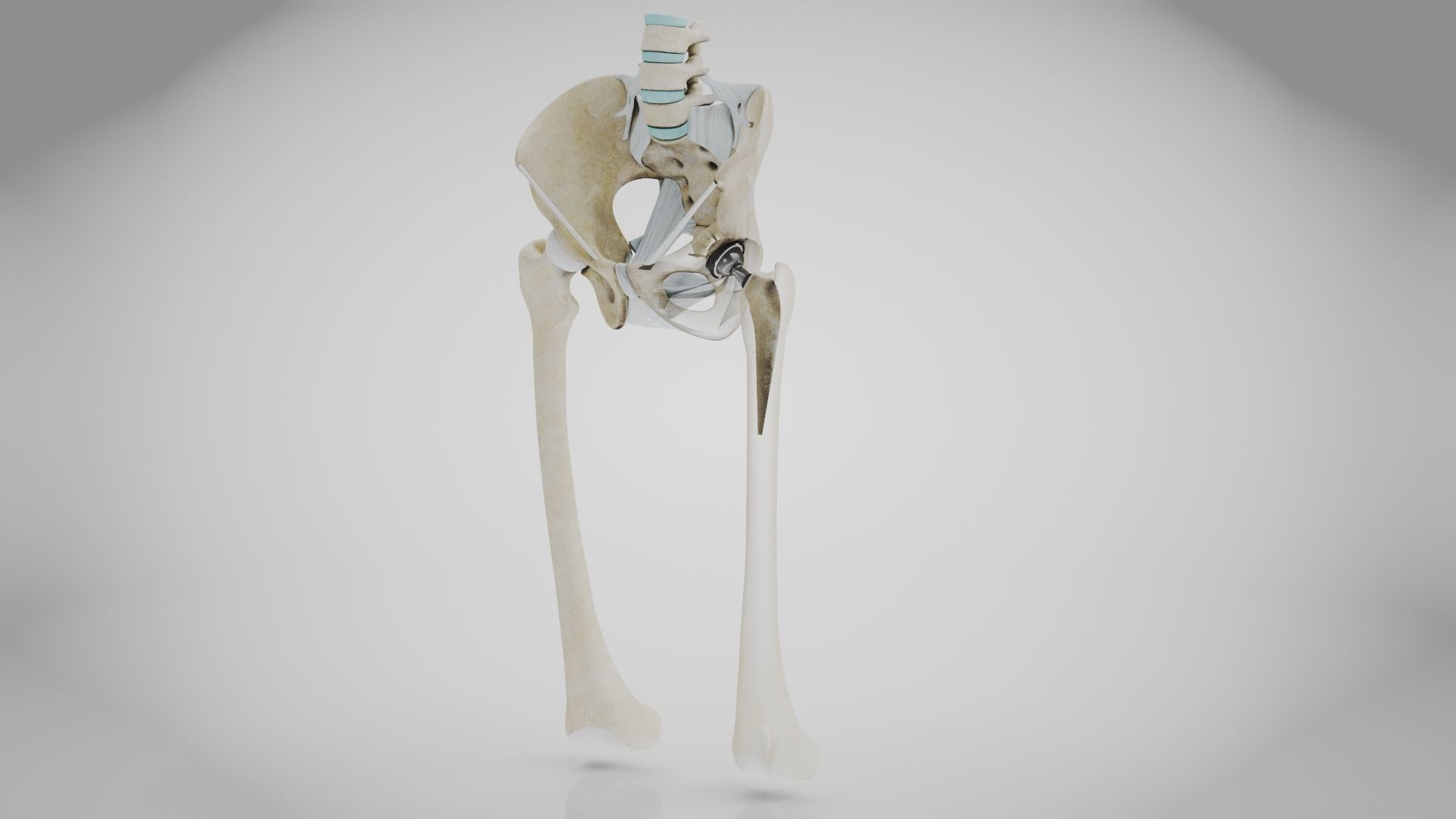 Replaced Hip Implant Low-poly 3D model_6
