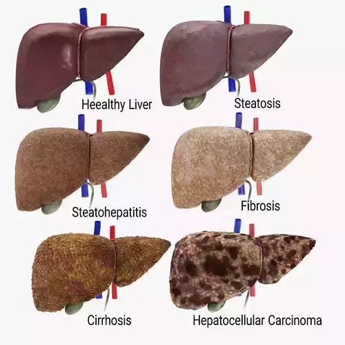 Liver Diseases Low-poly 3D model