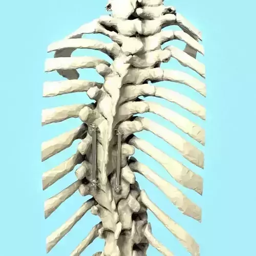 Spine Implant 3D model