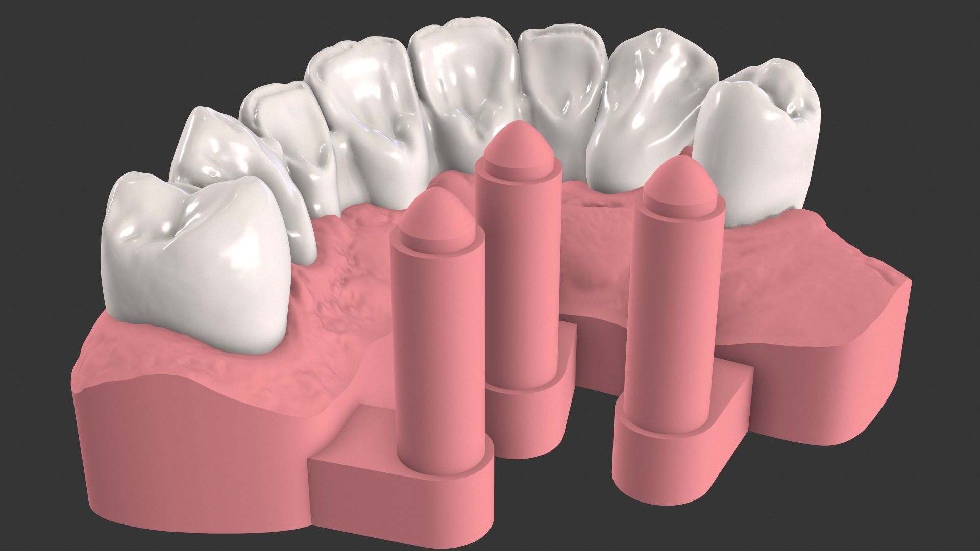 Dental Anatomy Bridge Real medical case  3D print model_8