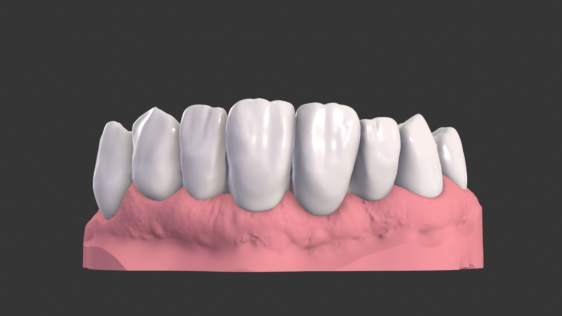 Dental Anatomy Bridge Real medical case  3D print model_6