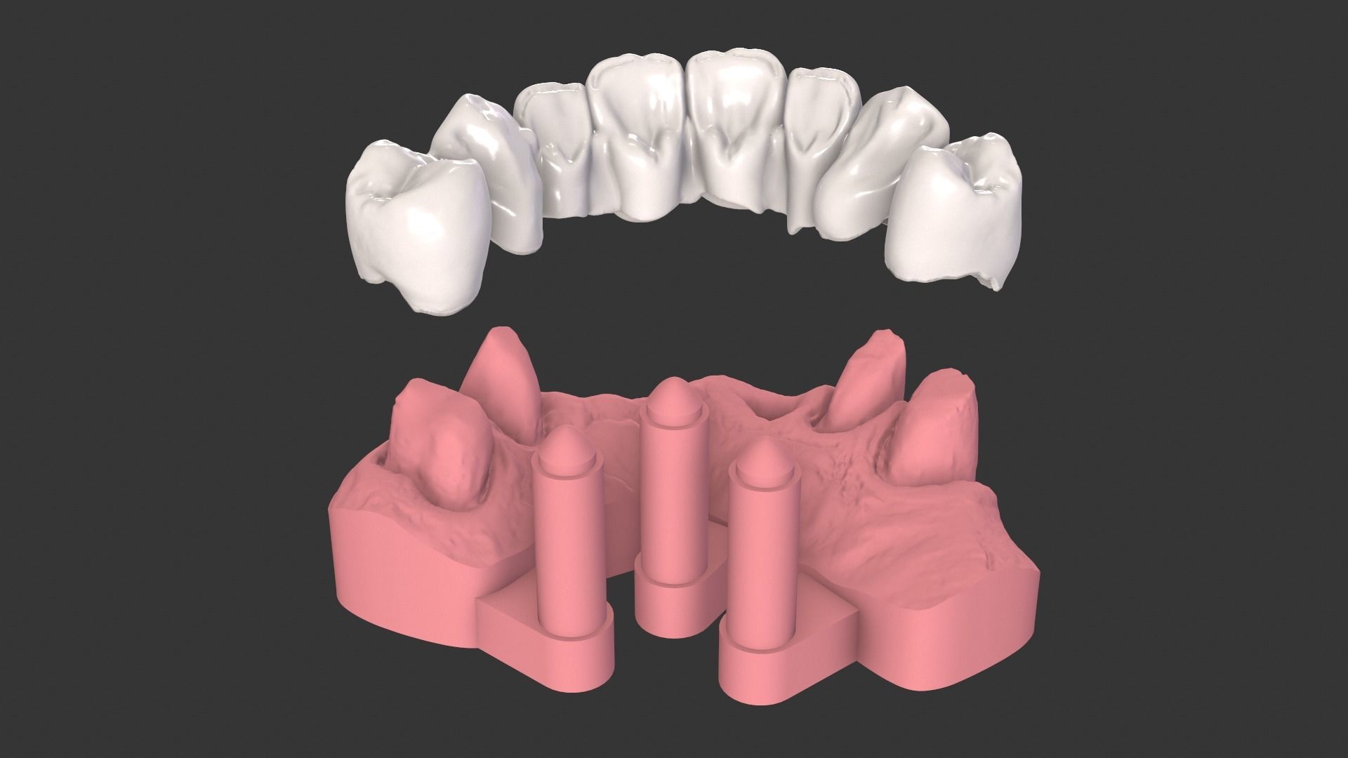 Dental Anatomy Bridge Real medical case  3D print model_2