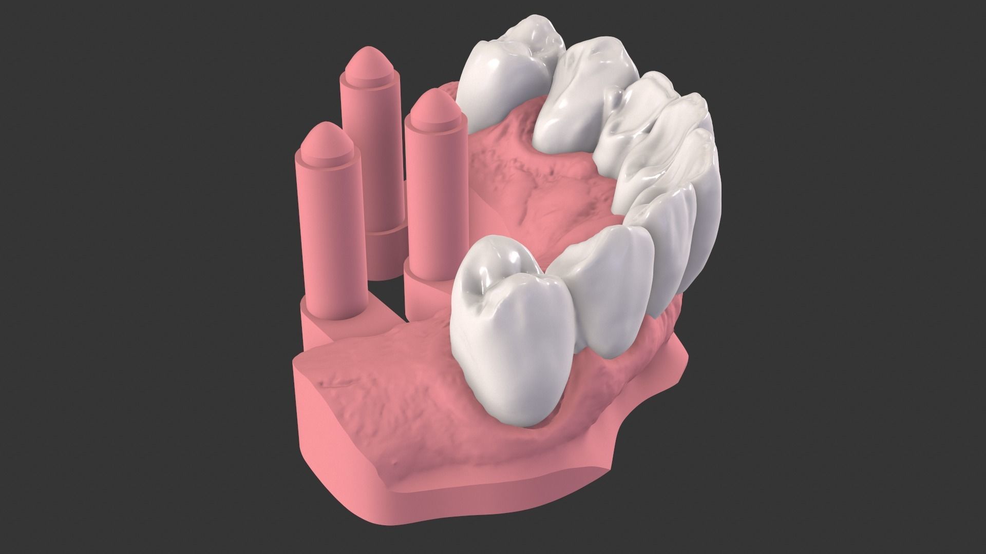 Dental Anatomy Bridge Real medical case  3D print model_9