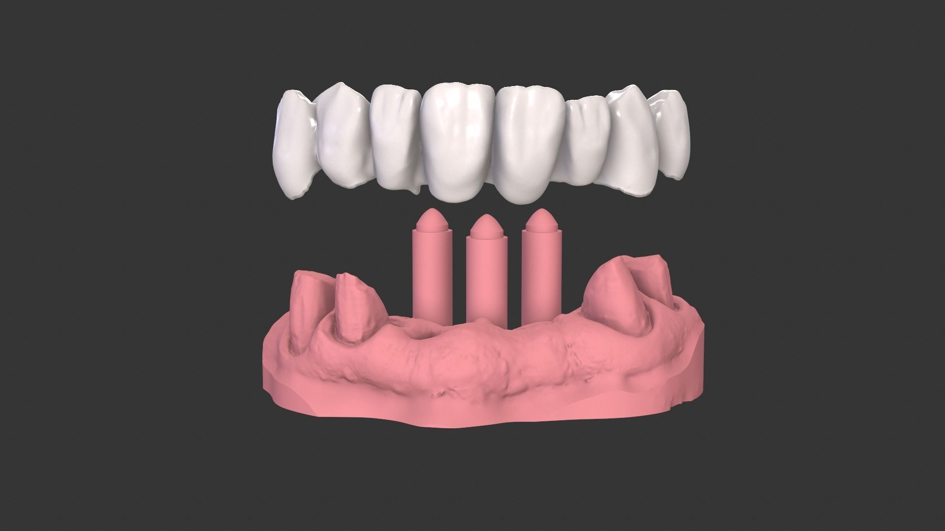 Dental Anatomy Bridge Real medical case  3D print model_4