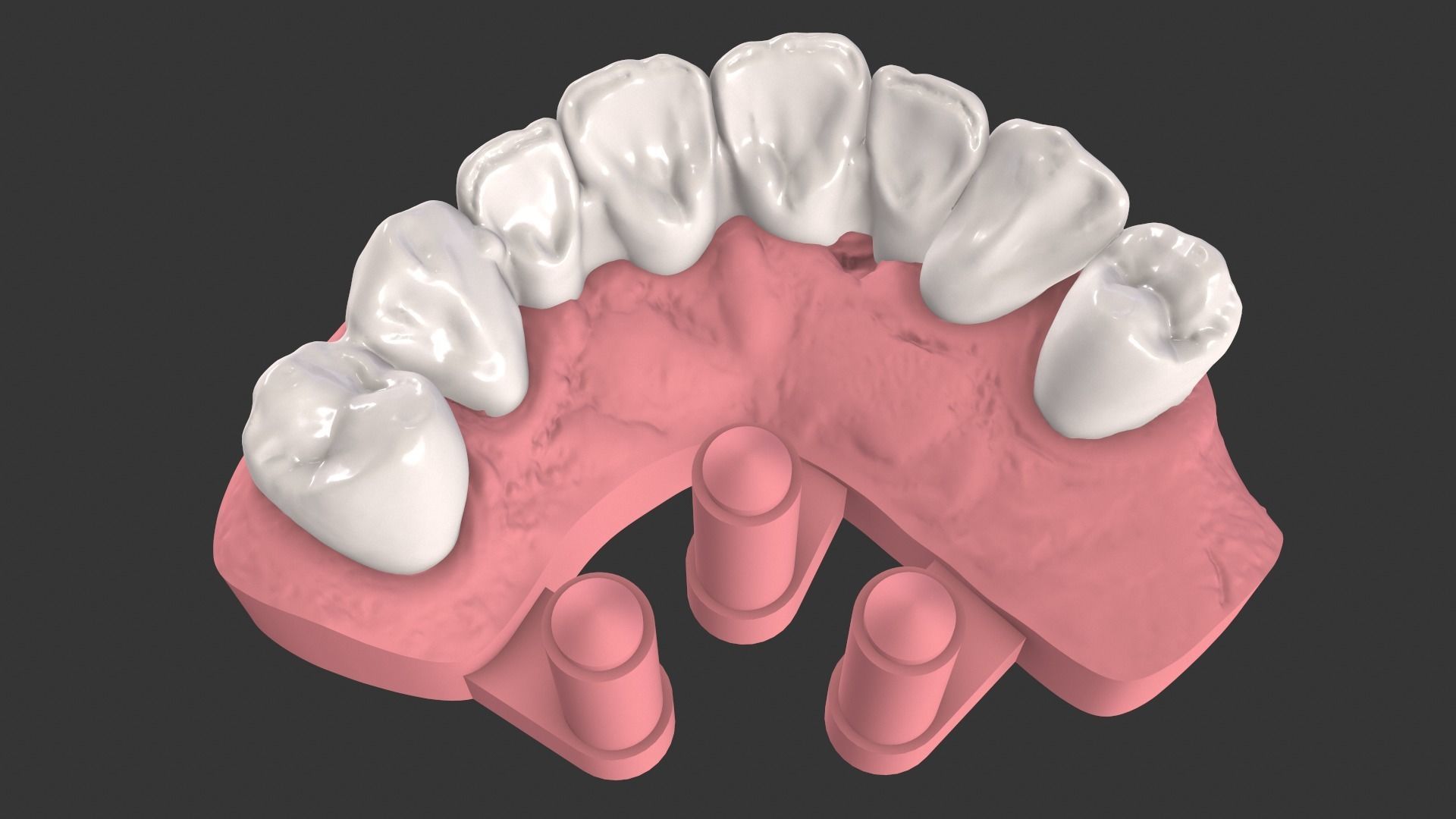 Dental Anatomy Bridge Real medical case  3D print model_7