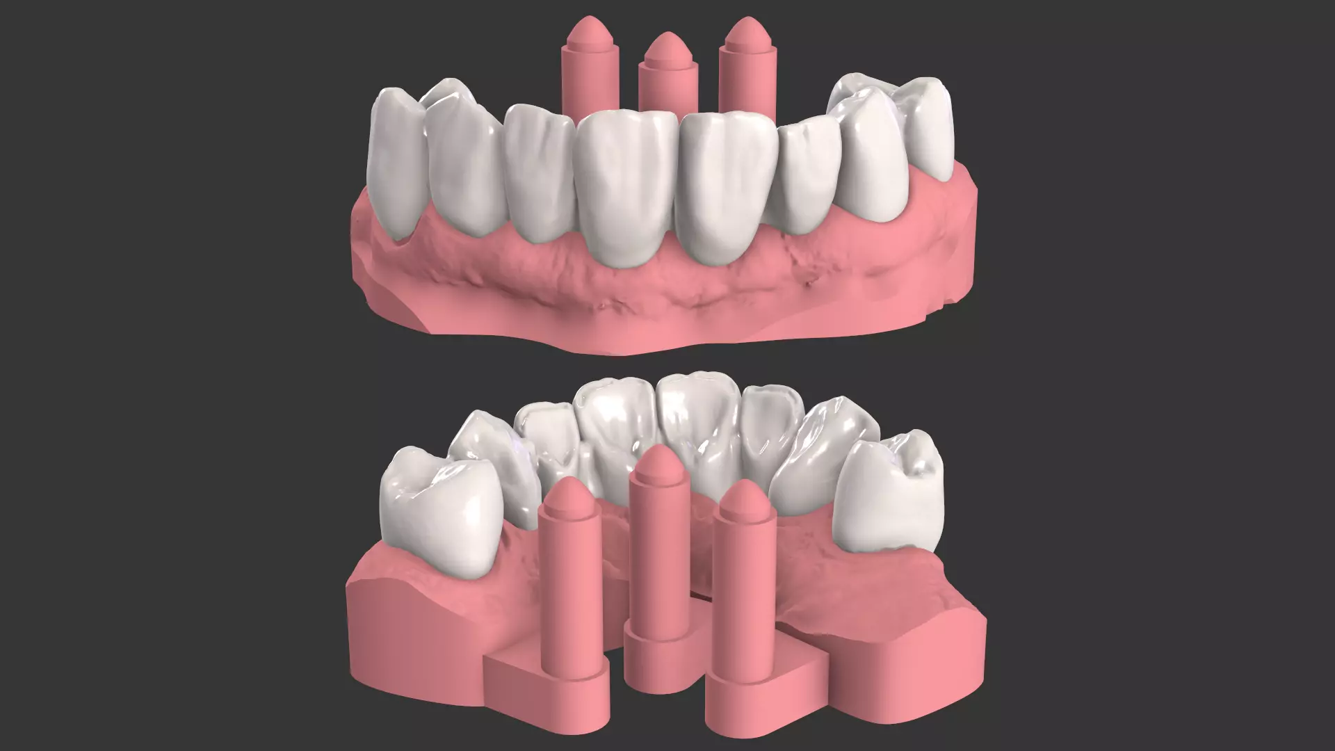 Dental Anatomy Bridge Real medical case  3D print model_0