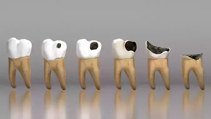 Human Tooth Decay A 3D Dental Caries Progression Model Low-poly 3D model