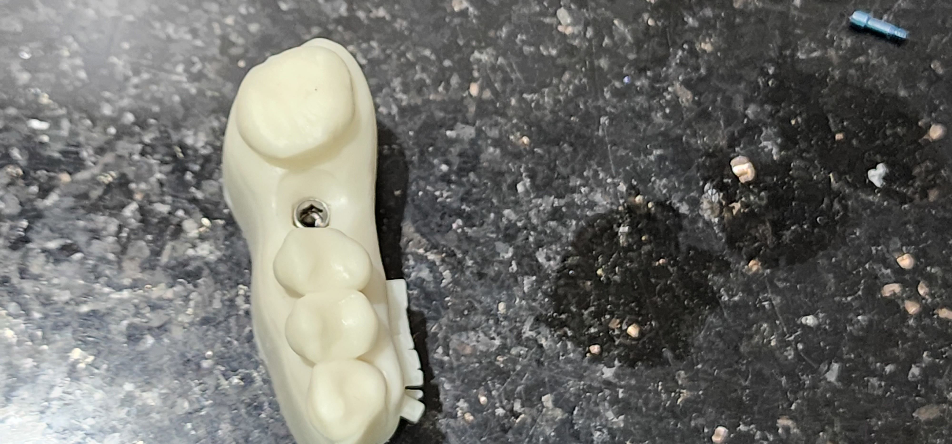 Digital Implant Model with a Metal Analog for 3D print model_13