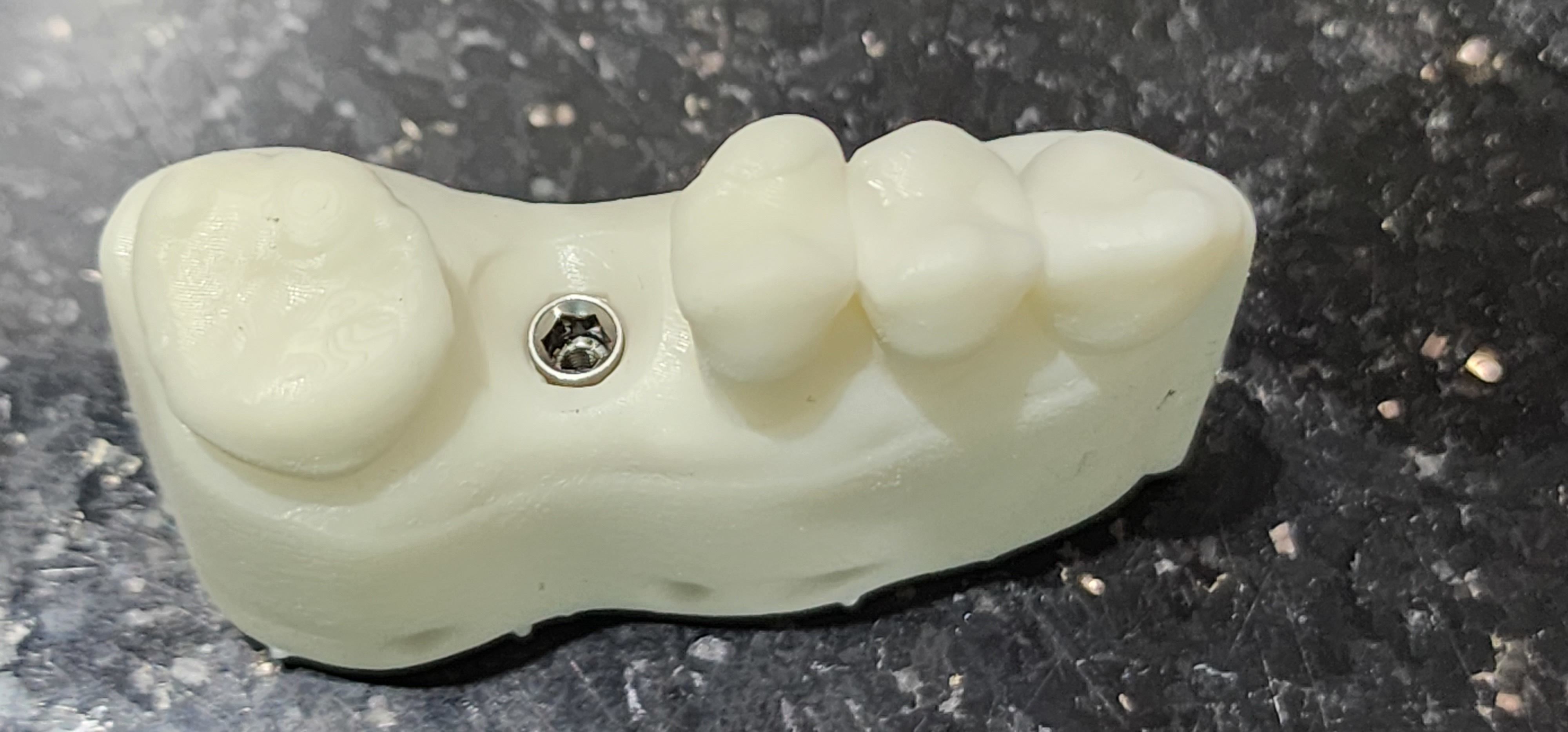 Digital Implant Model with a Metal Analog for 3D print model_12