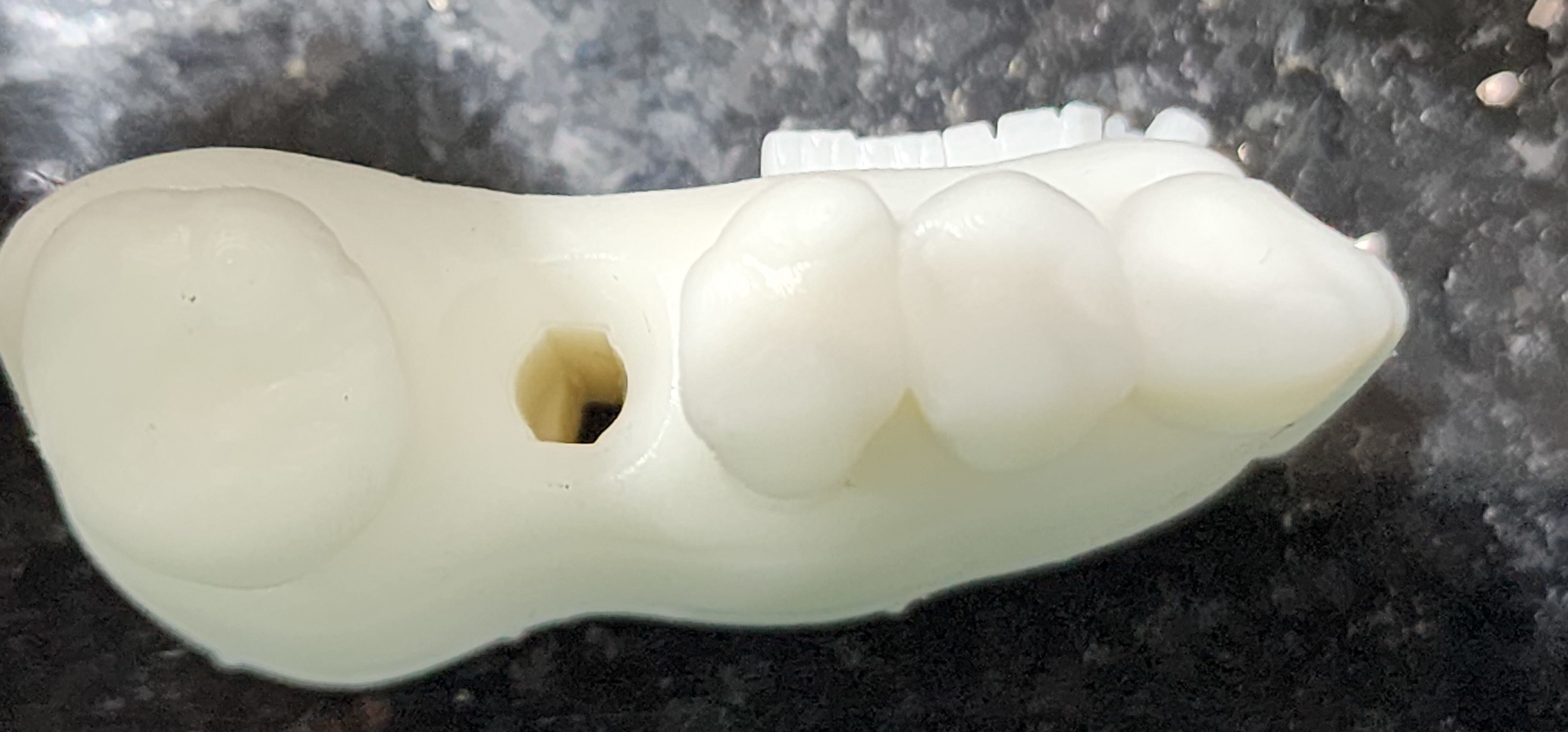 Digital Implant Model with a Metal Analog for 3D print model_10