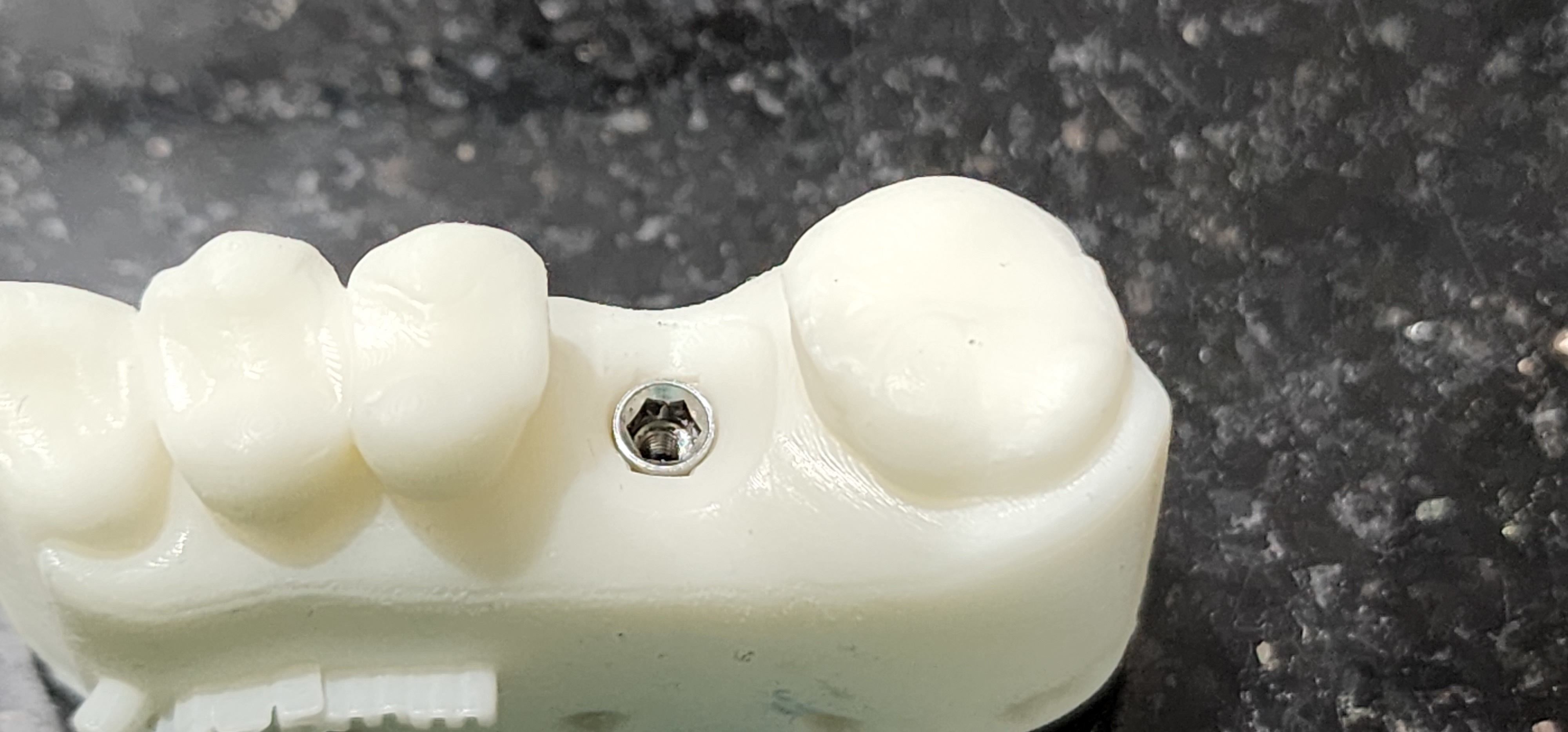 Digital Implant Model with a Metal Analog for 3D print model_15