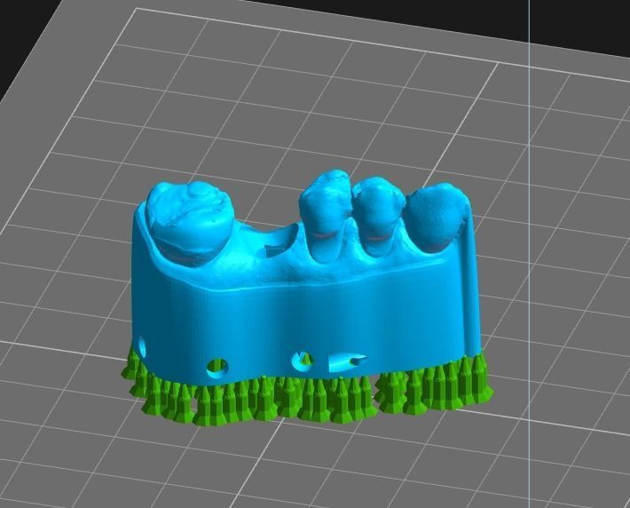 Digital Implant Model with a Metal Analog for 3D print model_21