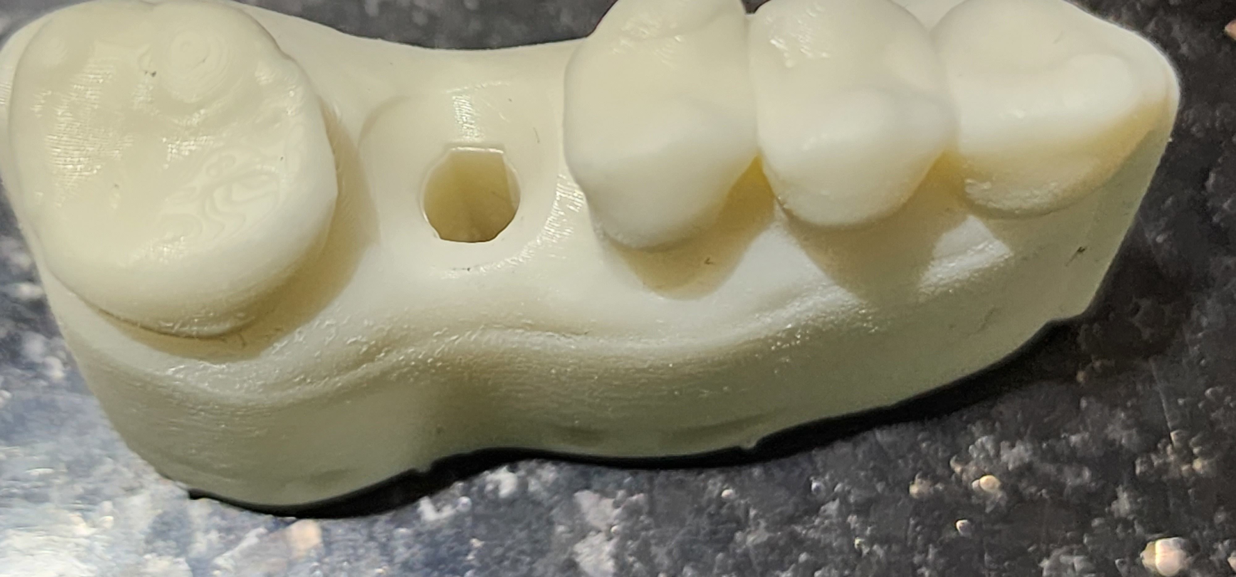 Digital Implant Model with a Metal Analog for 3D print model_9