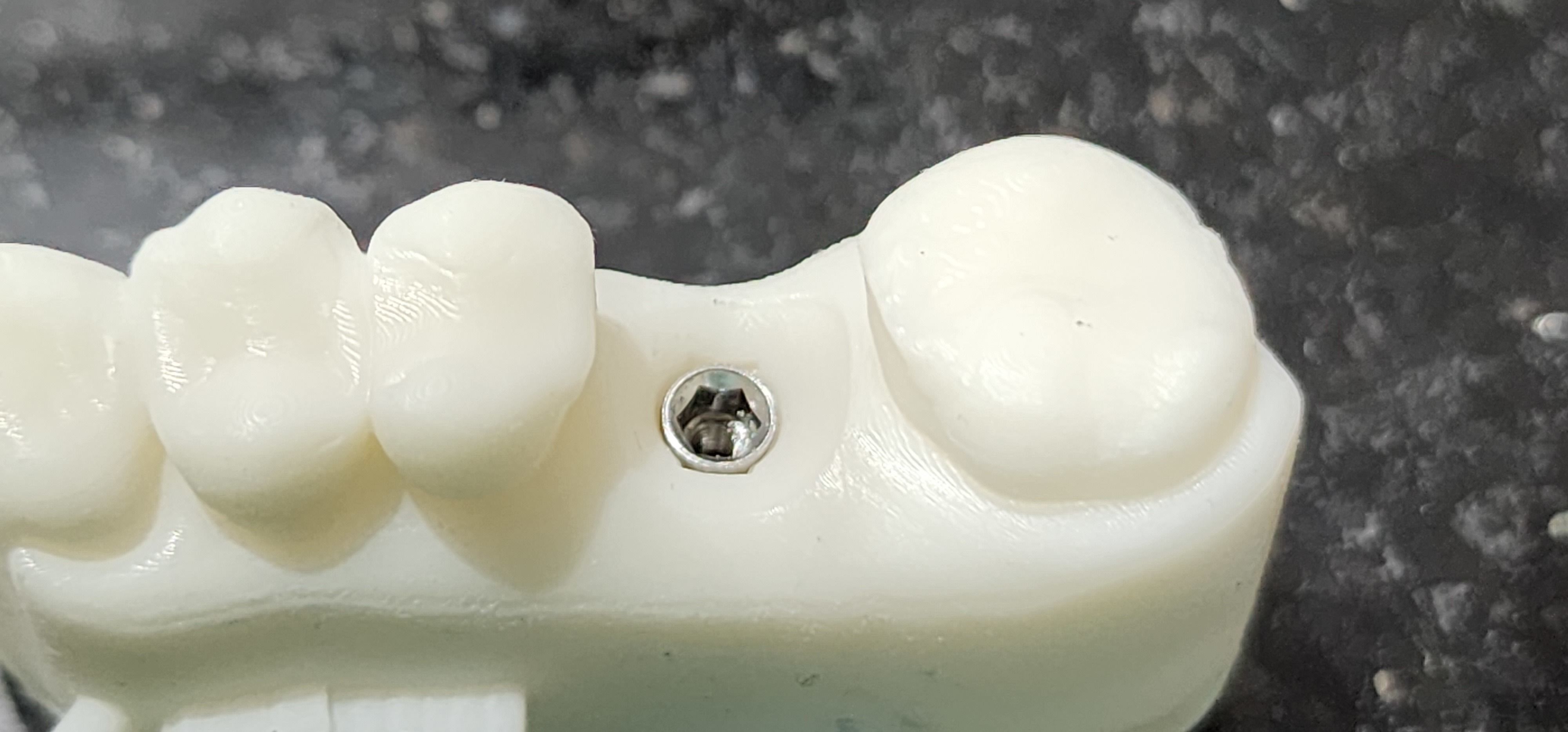 Digital Implant Model with a Metal Analog for 3D print model_14