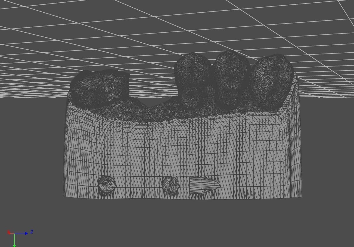 Digital Implant Model with a Metal Analog for 3D print model_22