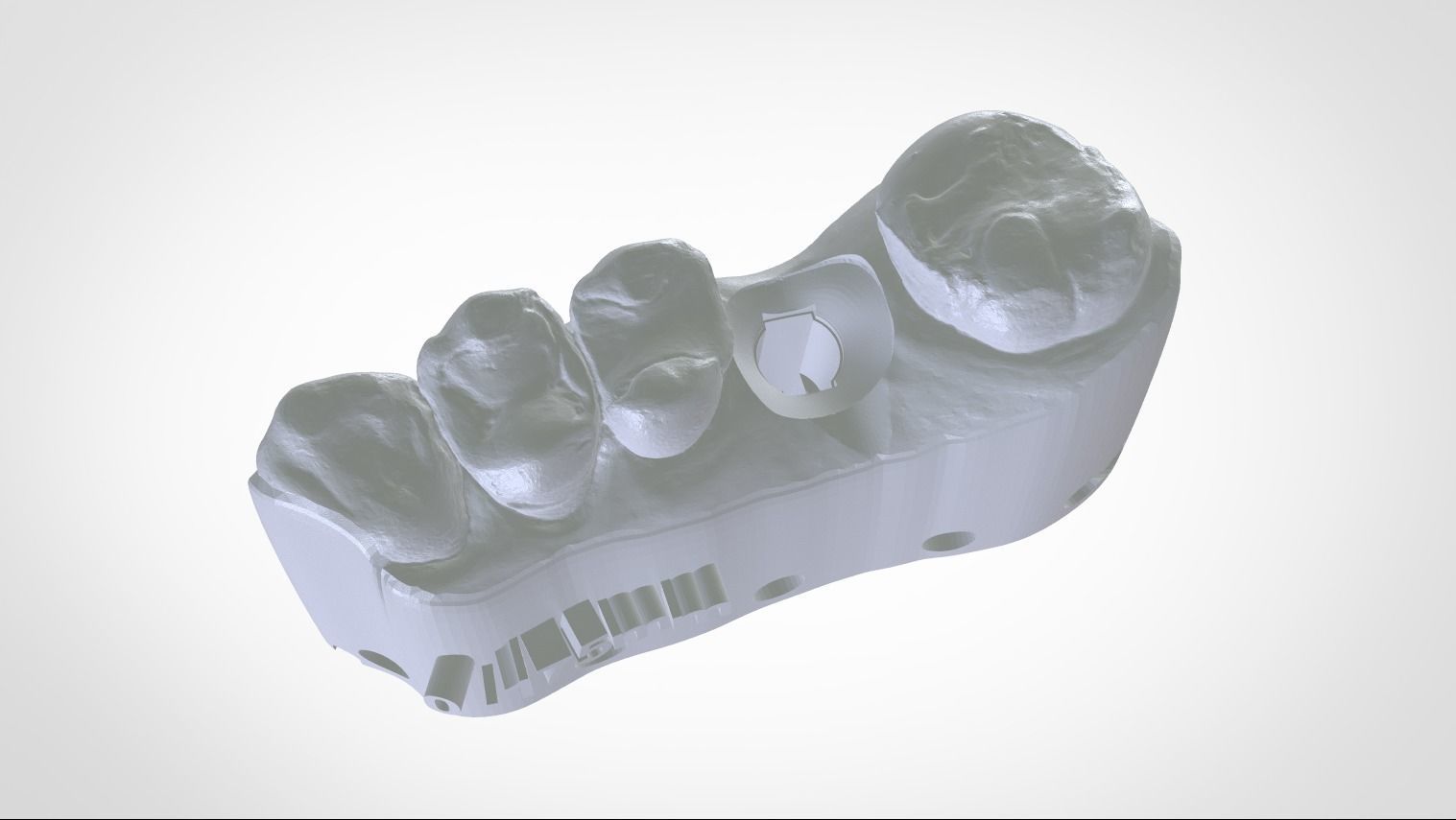 Digital Implant Model with a Metal Analog for 3D print model_2