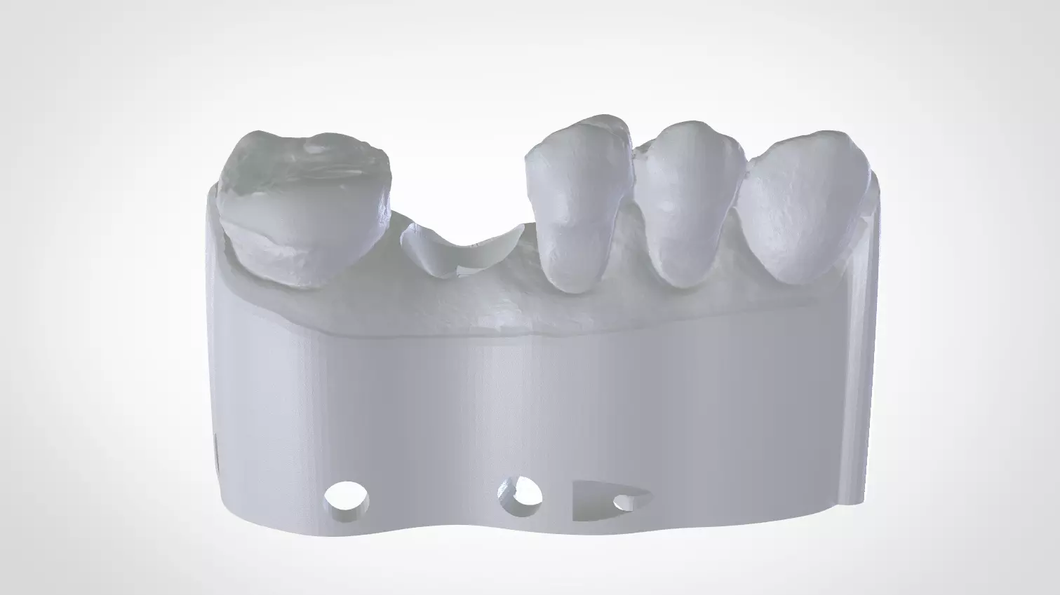 Digital Implant Model with a Metal Analog for 3D print model_0