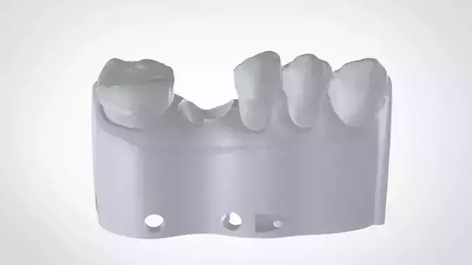 Digital Implant Model with a Metal Analog for