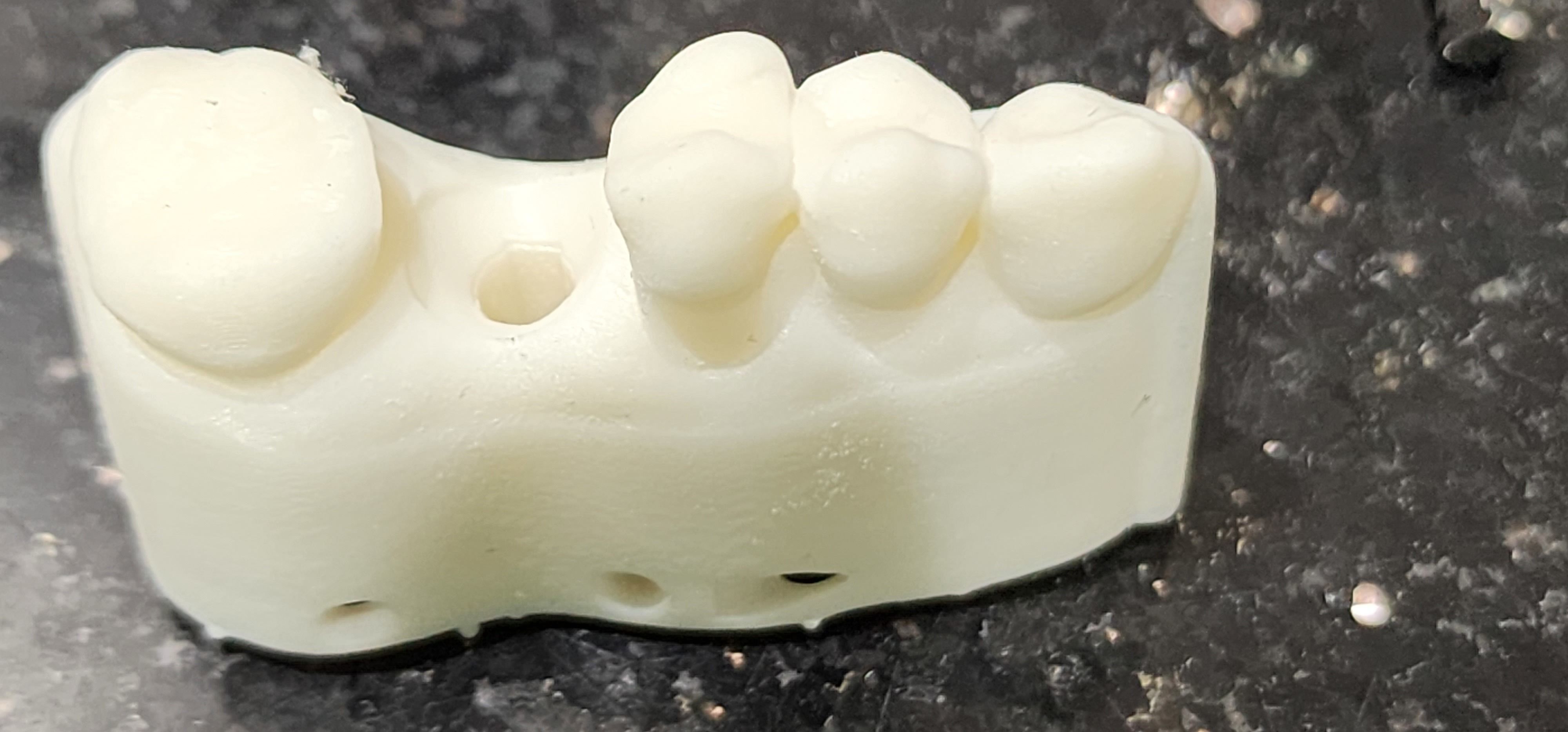 Digital Implant Model with a Metal Analog for 3D print model_3