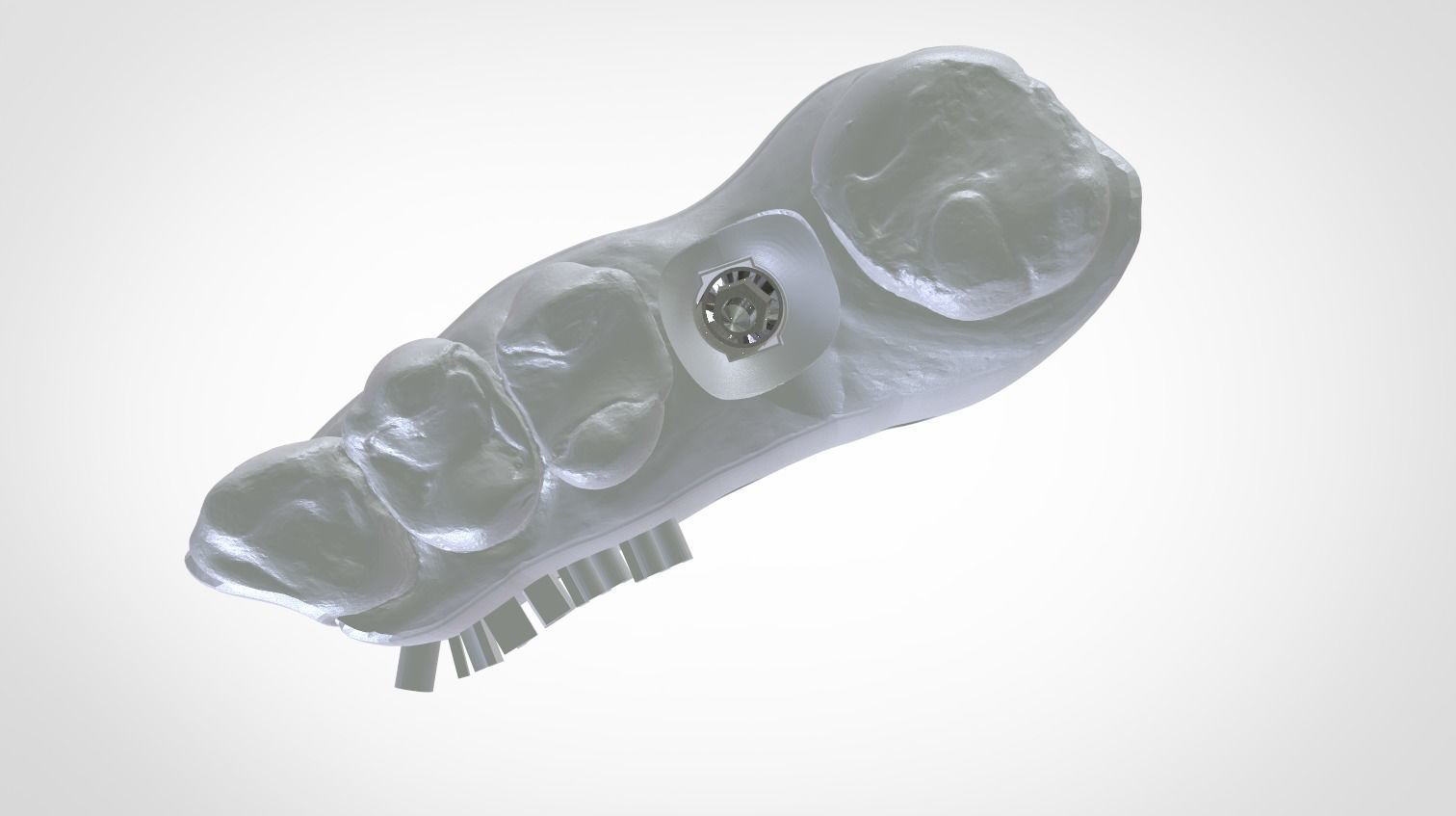 Digital Implant Model with a Metal Analog for 3D print model_19