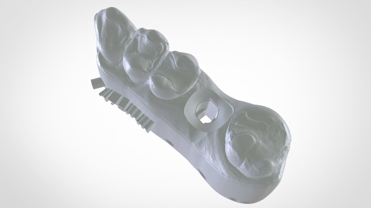 Digital Implant Model with a Metal Analog for 3D print model_16