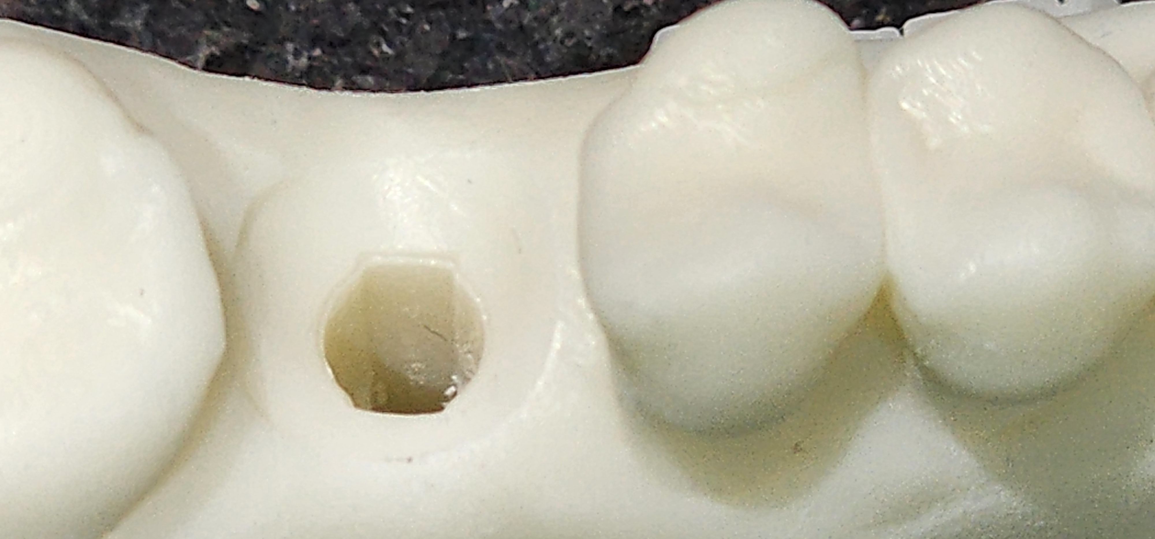 Digital Implant Model with a Metal Analog for 3D print model_11