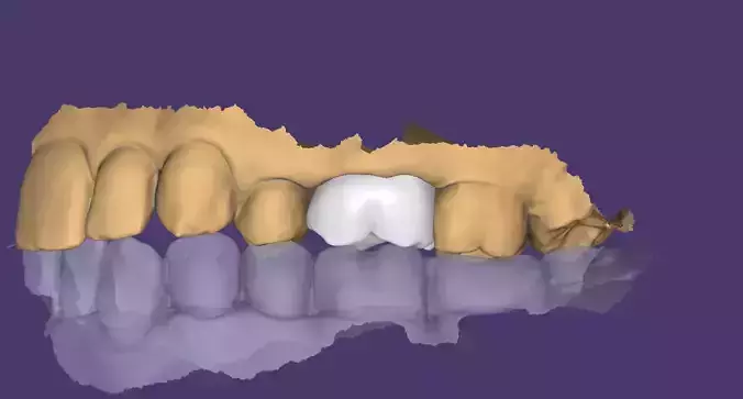 High-Quality Molar Crown 3D Model