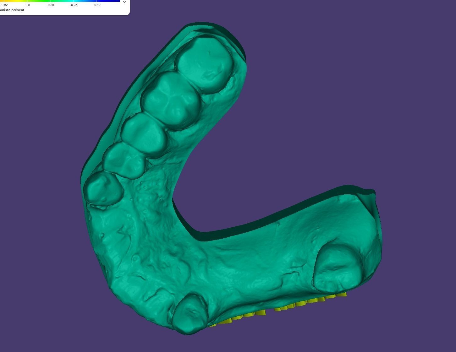 Educational Partial Denture 3D Model for Dental Students 3D model_1