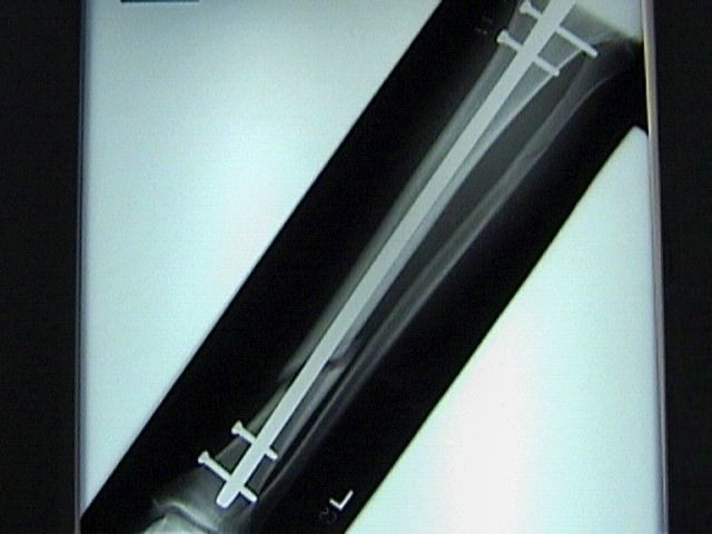 Tibial Intramedullary Nail 3D model_5