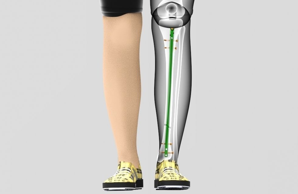 Tibial Intramedullary Nail 3D model_3