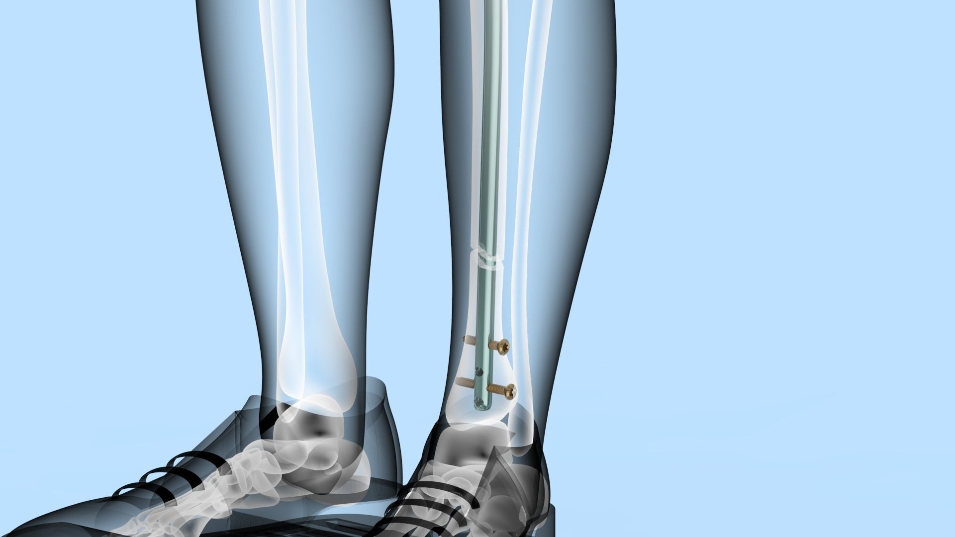 Tibial Intramedullary Nail 3D model_6