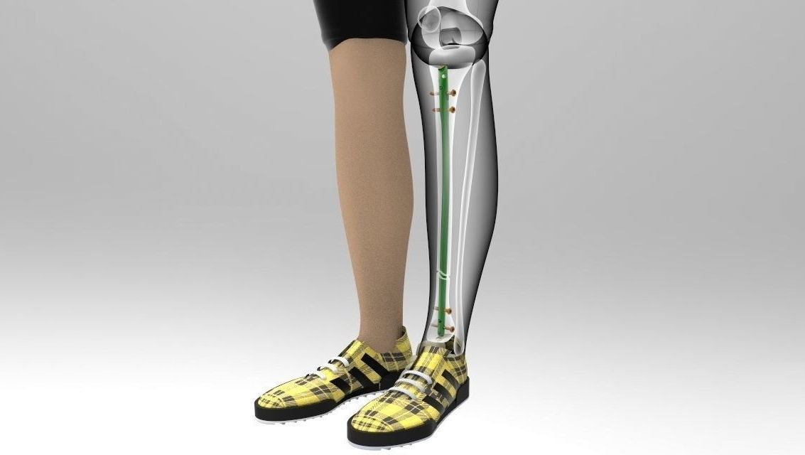 Tibial Intramedullary Nail 3D model_7