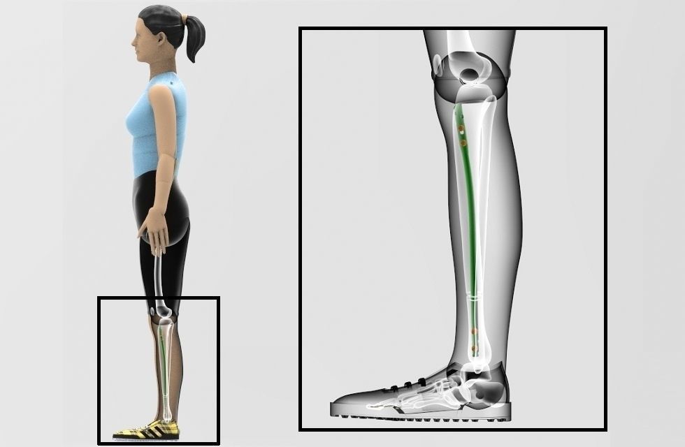 Tibial Intramedullary Nail 3D model_4