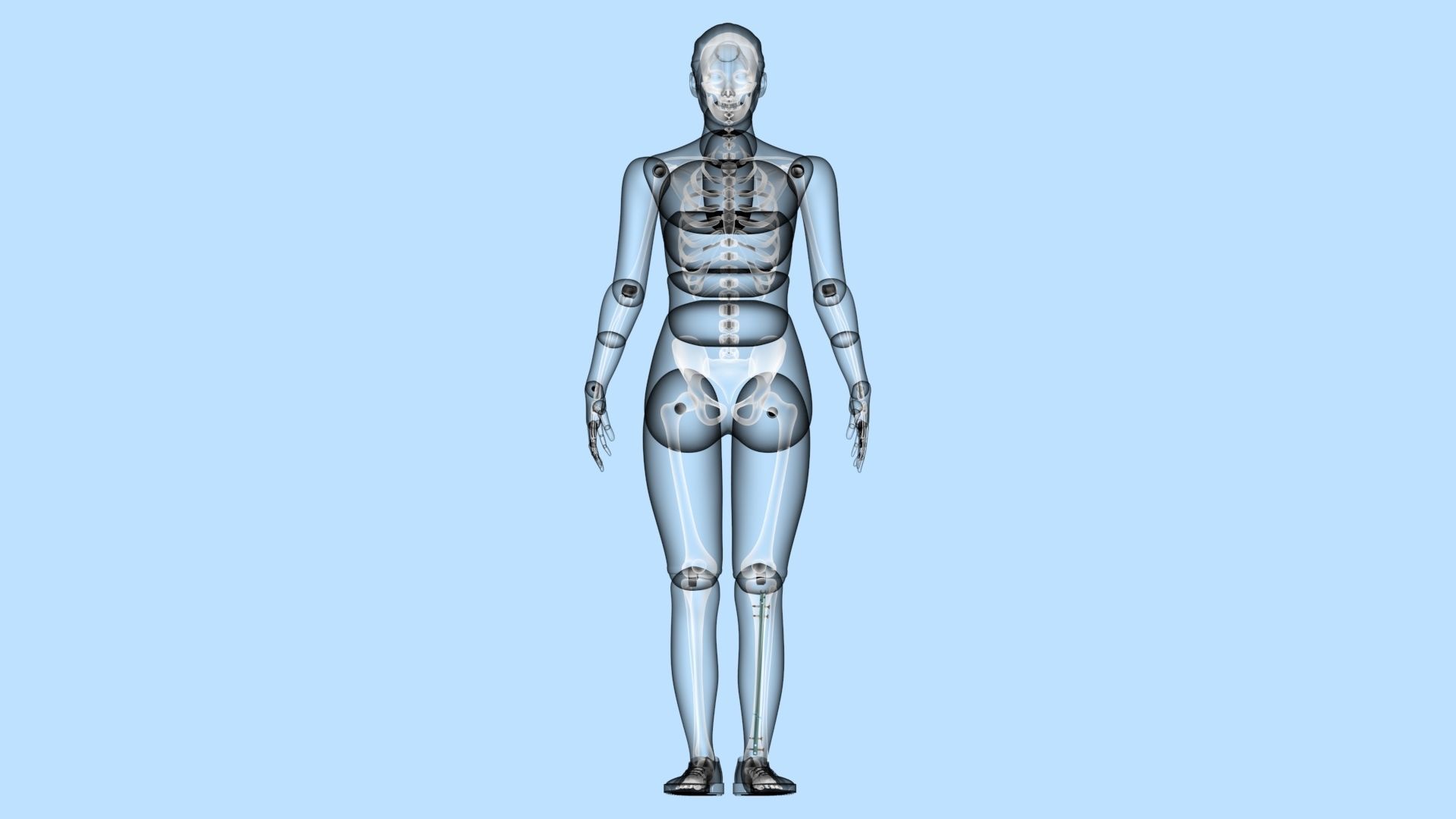 Tibial Intramedullary Nail 3D model_12