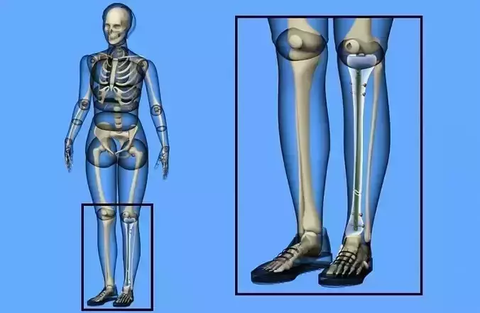 Tibial Intramedullary Nail 3D model