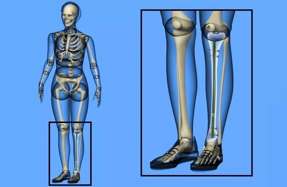 Tibial Intramedullary Nail 3D model_0