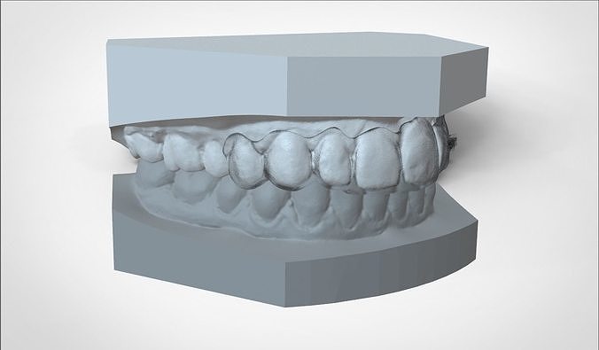 Digital Ortho Mini Deprogrammer Splint 3D print model