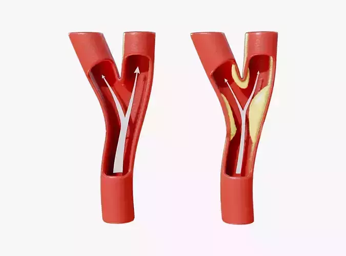 Peripheral Artery Disease Low-poly 3D model