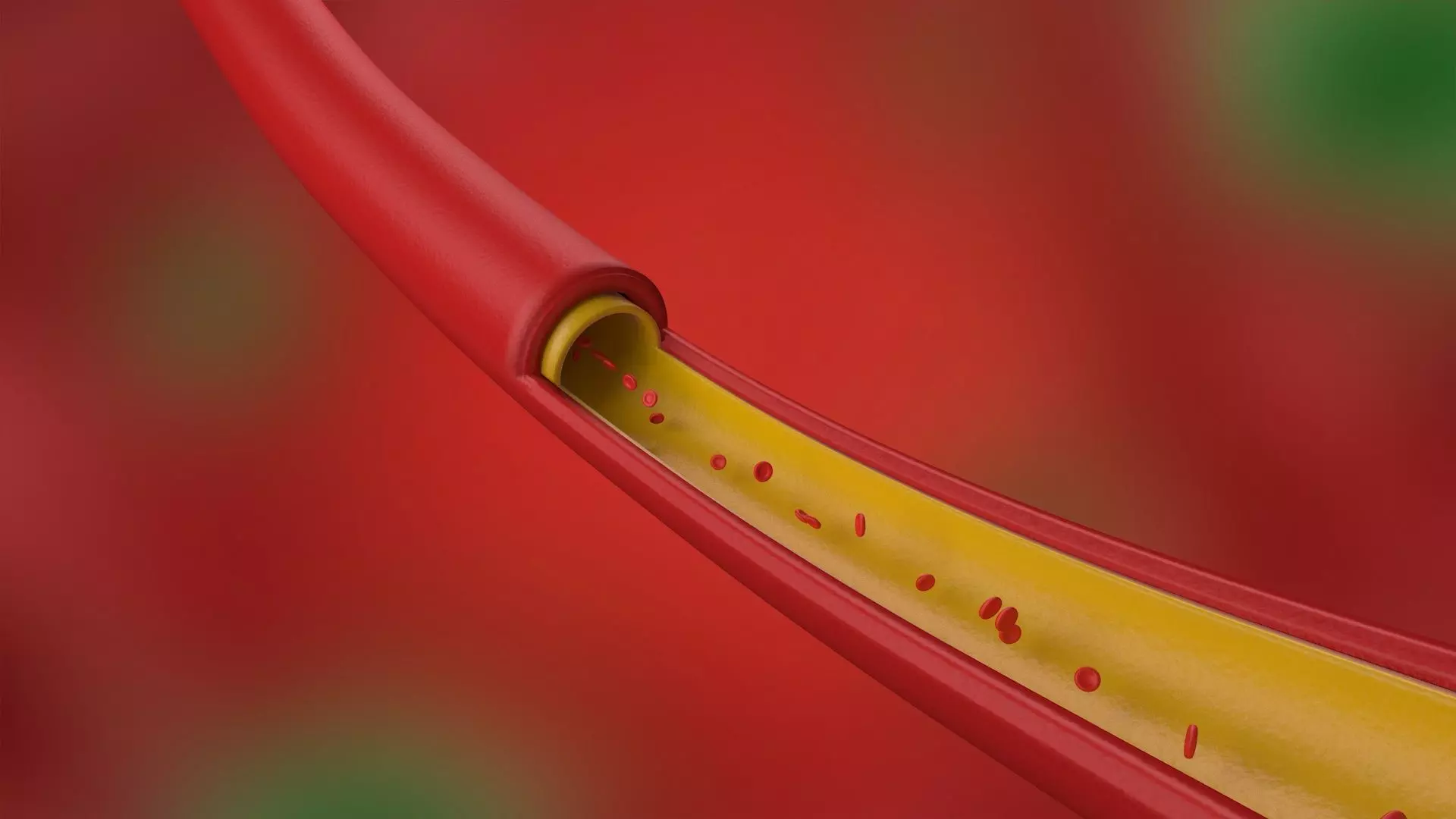 Artery Vein Clog Clot Clogged Stream Bloodflow Layers Section 3D model