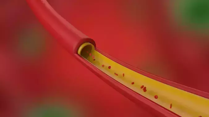 Artery Vein Clog Clot Clogged Stream Bloodflow Layers Section