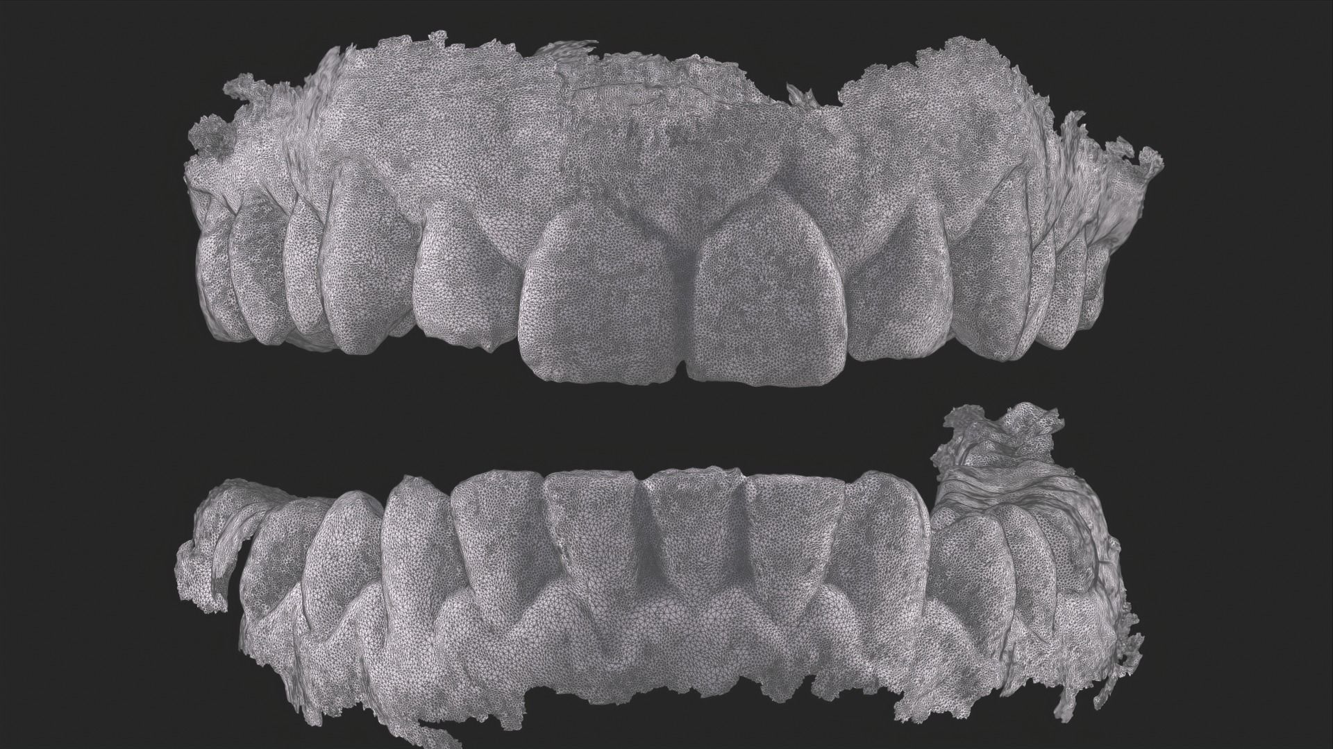 Dental Mouth Anatomy 3 Real Medical Cases Upper and Lower Jaw 3D print model_11